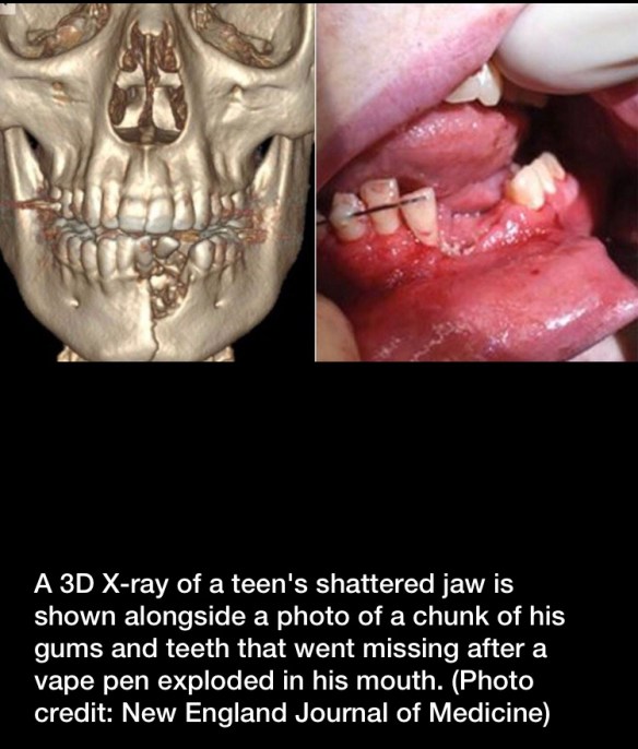 elfbar elfa master akku Vape pen explosion shattered teen's jaw, doctors say